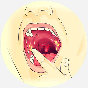 tonsil stones